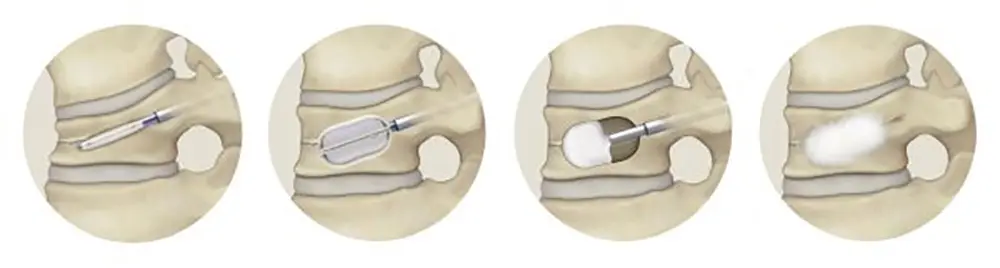 BKP（Balloon Kyphoplasty：経皮的椎体形成術）