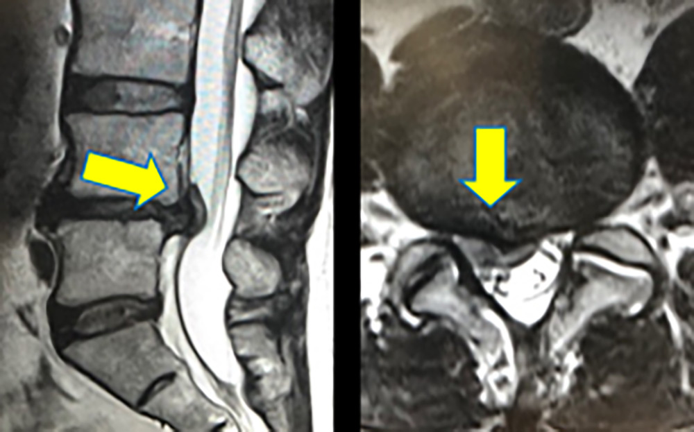 腰椎椎間板ヘルニアのMRI像