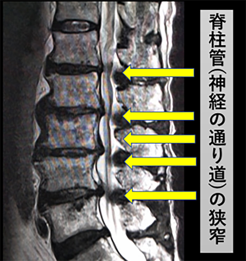 腰部脊柱管狭窄症のMRI像
