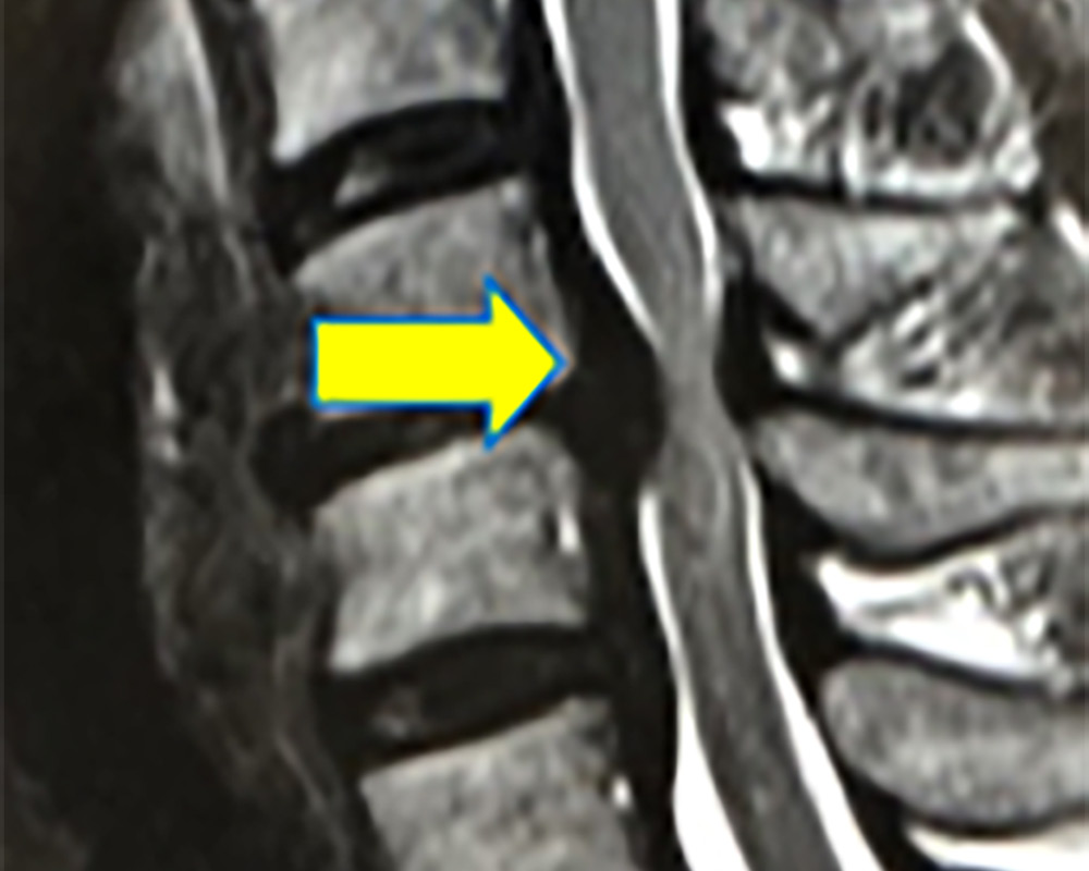 頚椎椎間板ヘルニアのMRI像