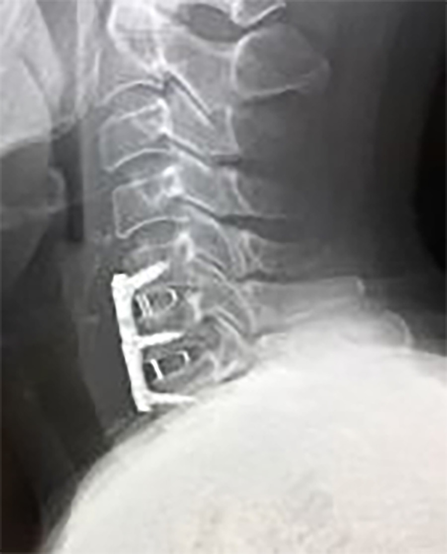 頚椎椎間板ヘルニアに対する頚椎前方除圧固定術