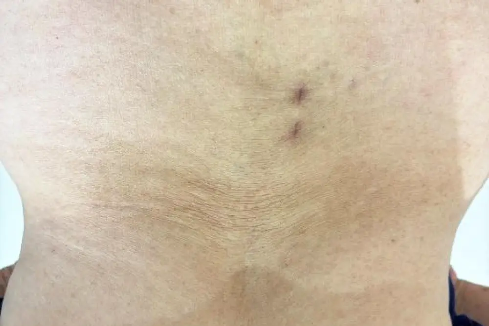 Biportal脊椎内視鏡手術（UBE手術）