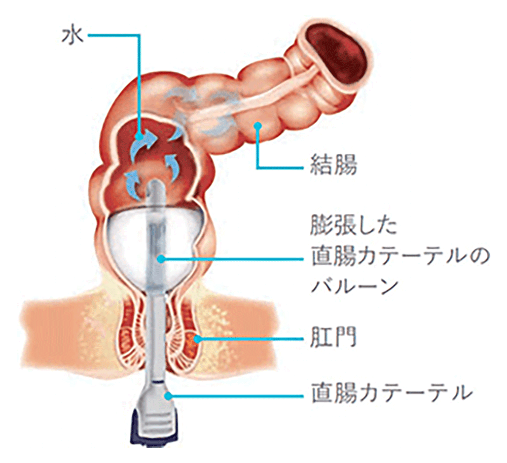 空気 浣腸